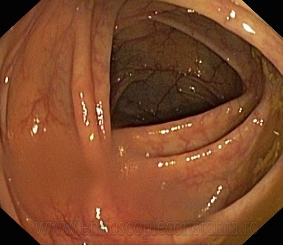 Endoscopie Constanta