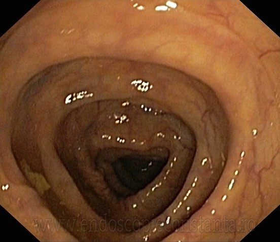 Colonoscopie Constanta